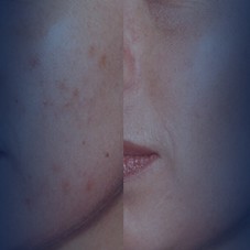 <a href="http://www.epibeauty.com/ar/sivilce-akne-tedavisi">علاج الحبوب وحب الشباب</a>